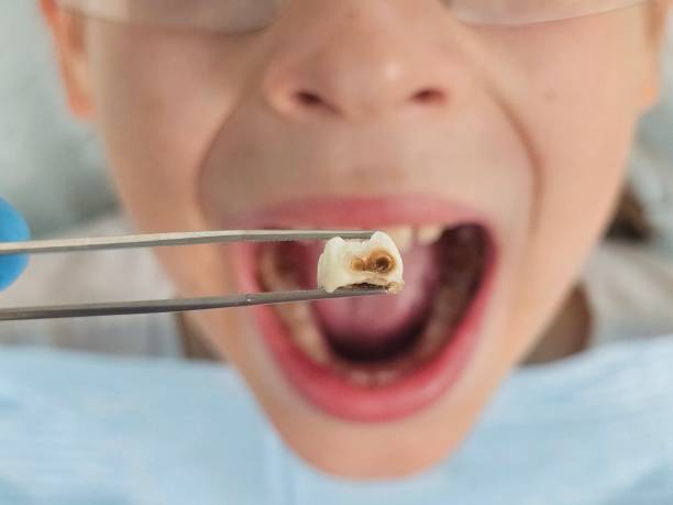Best Emergency Treatment for Dental Infections or Abscesses in Sparkill, NY